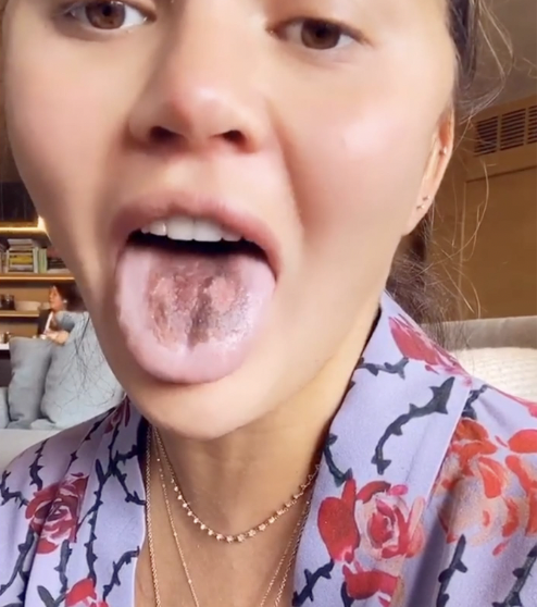 why sour candy sweets tongue sore peel